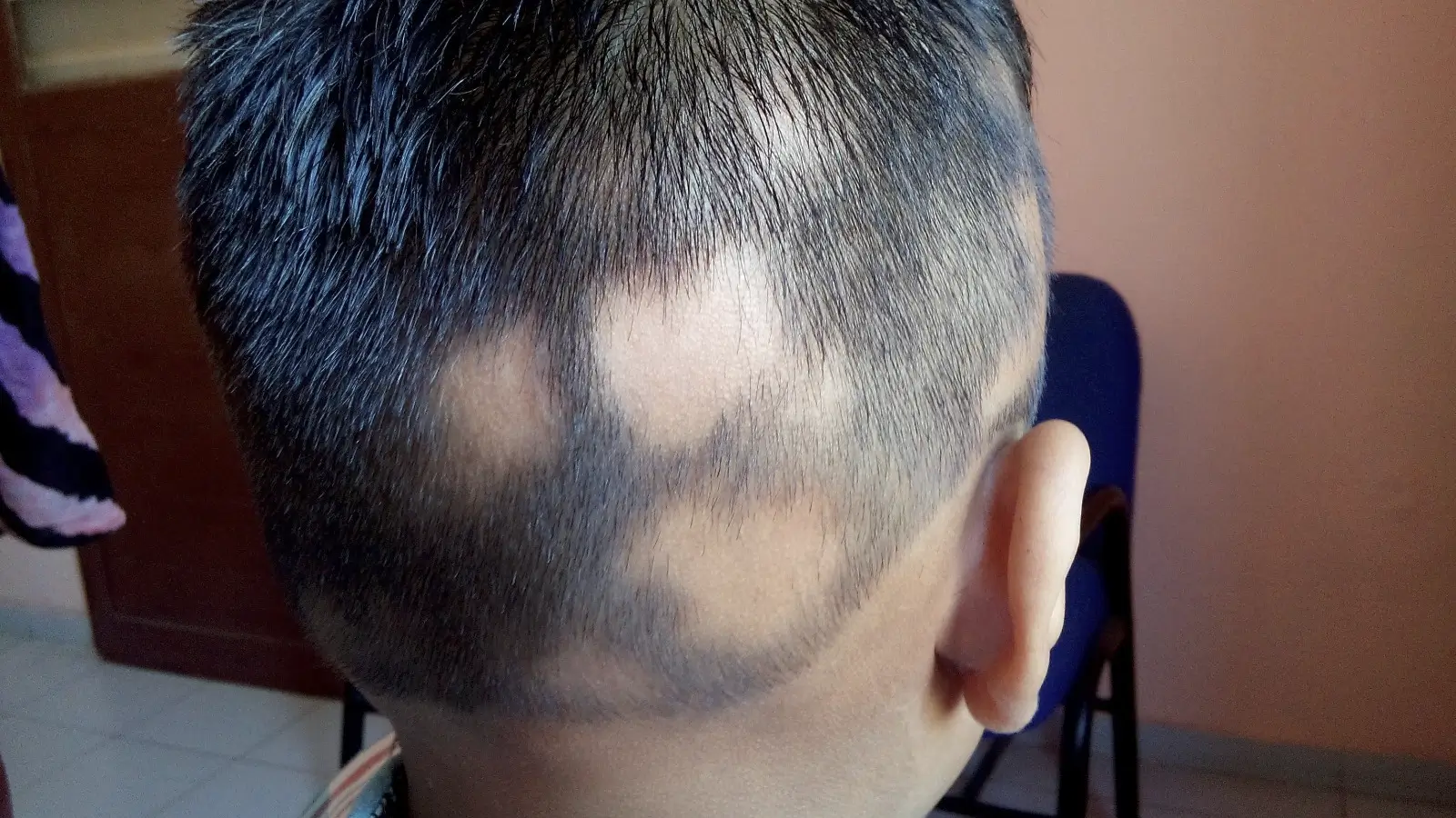 Alopecia Areata case 4 before treatment